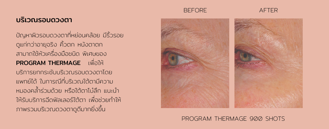 Thermage 9