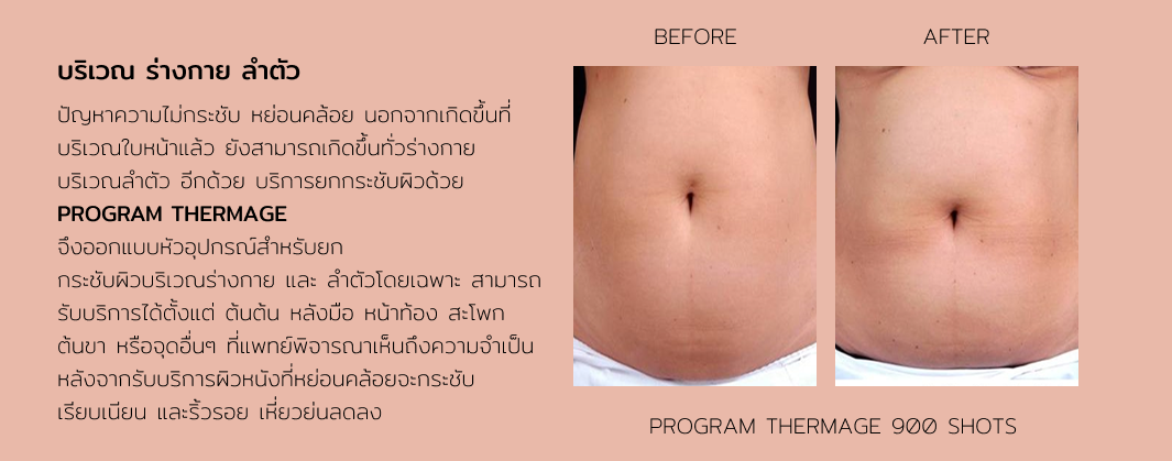 Thermage 10