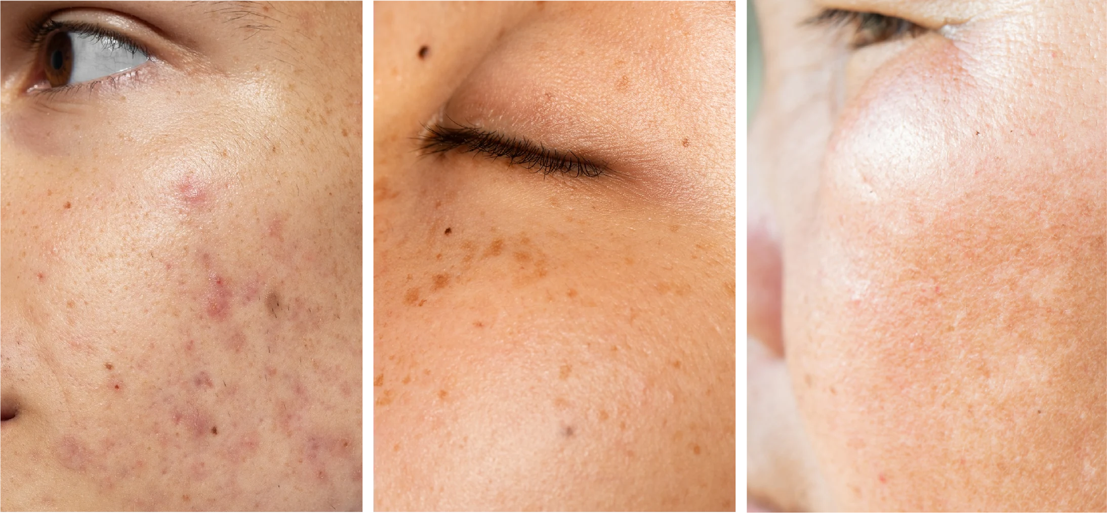 ฝ้า กระ จุดด่างดำ แก้ได้ด้วย PicoSure