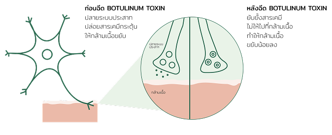 Botulinum toxin 3