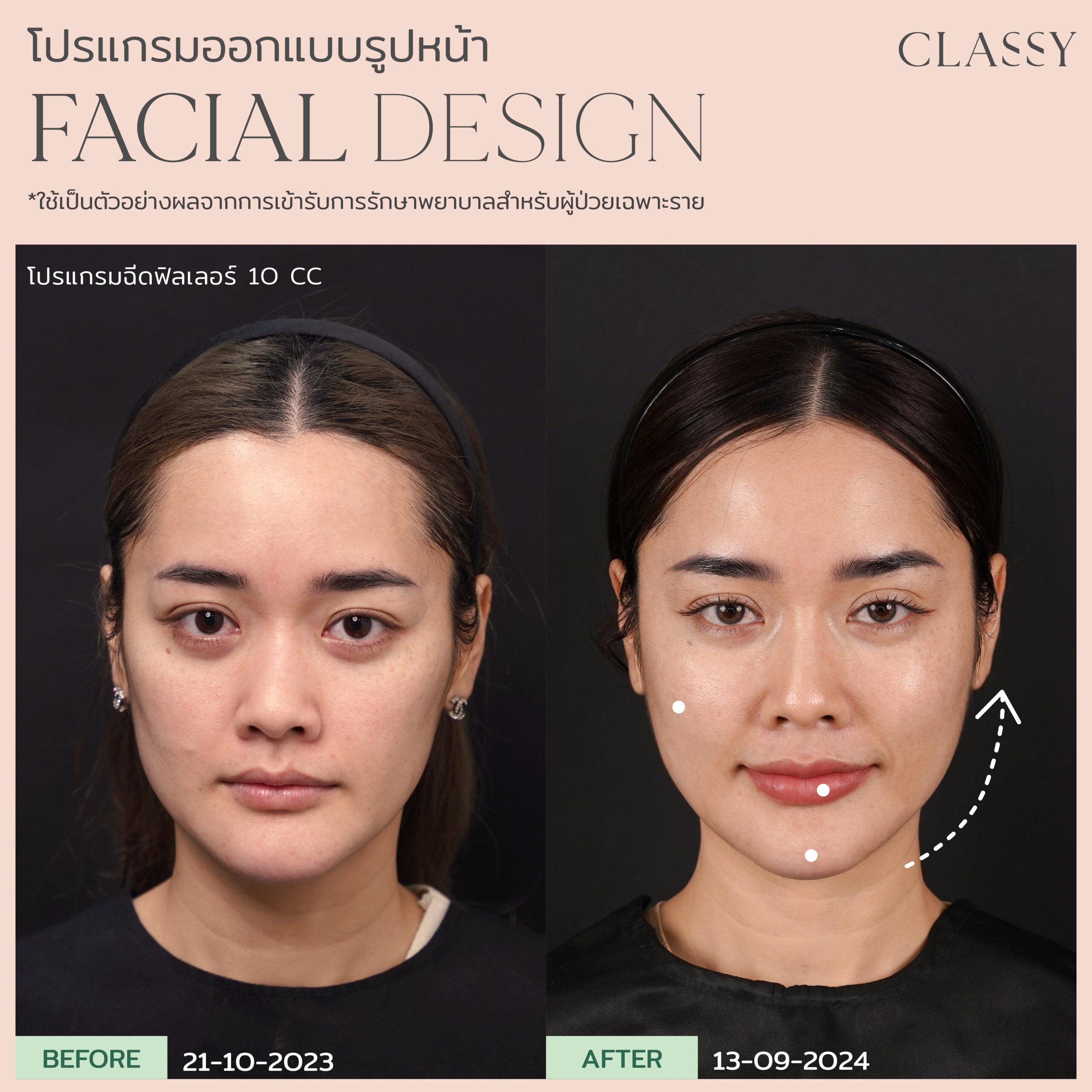 Before & After - Classy Clinic