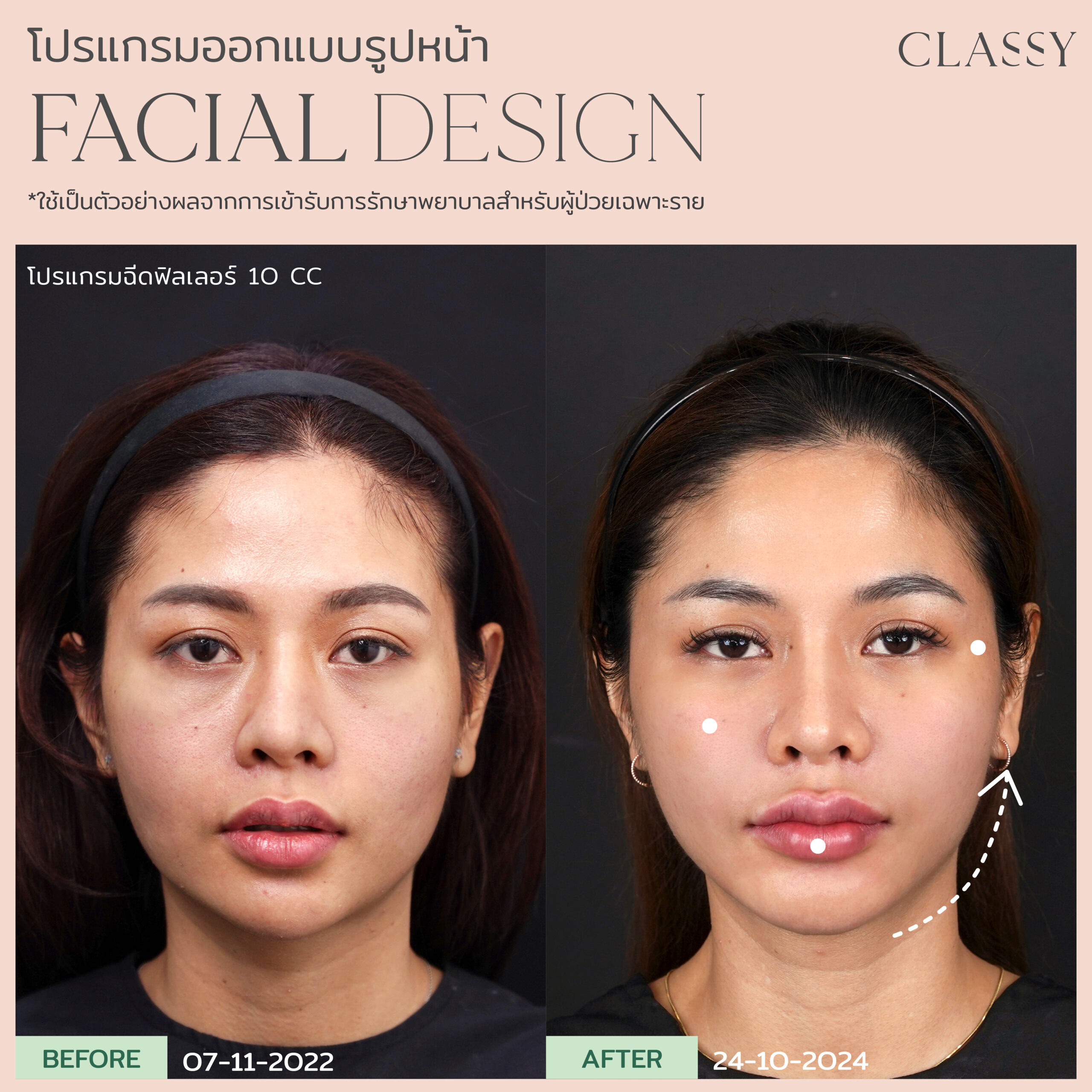 Before & After - Classy Clinic