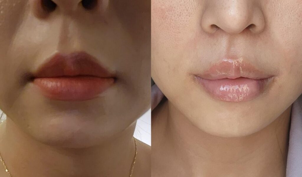 ฉีดยกมุมปาก