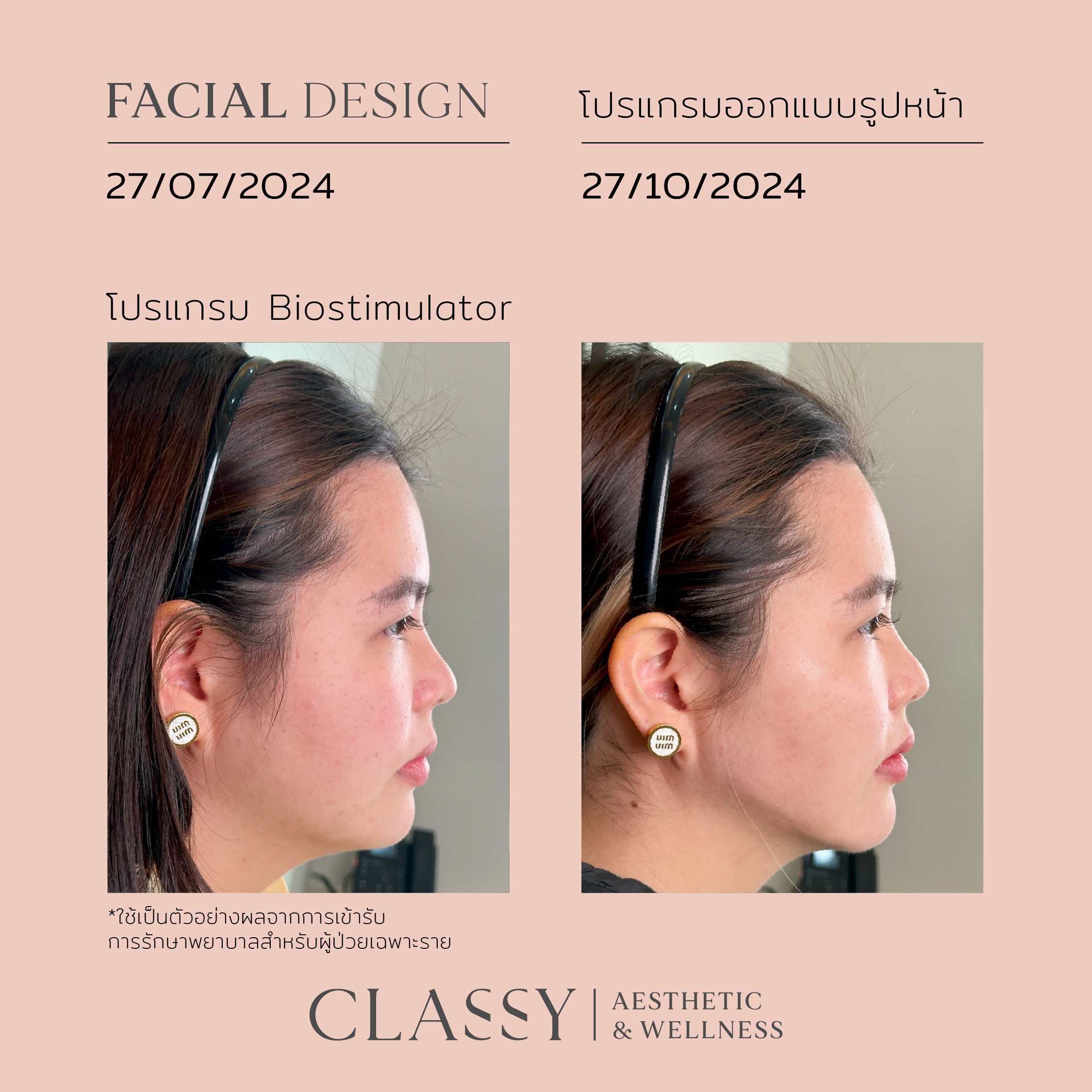 เนส-11