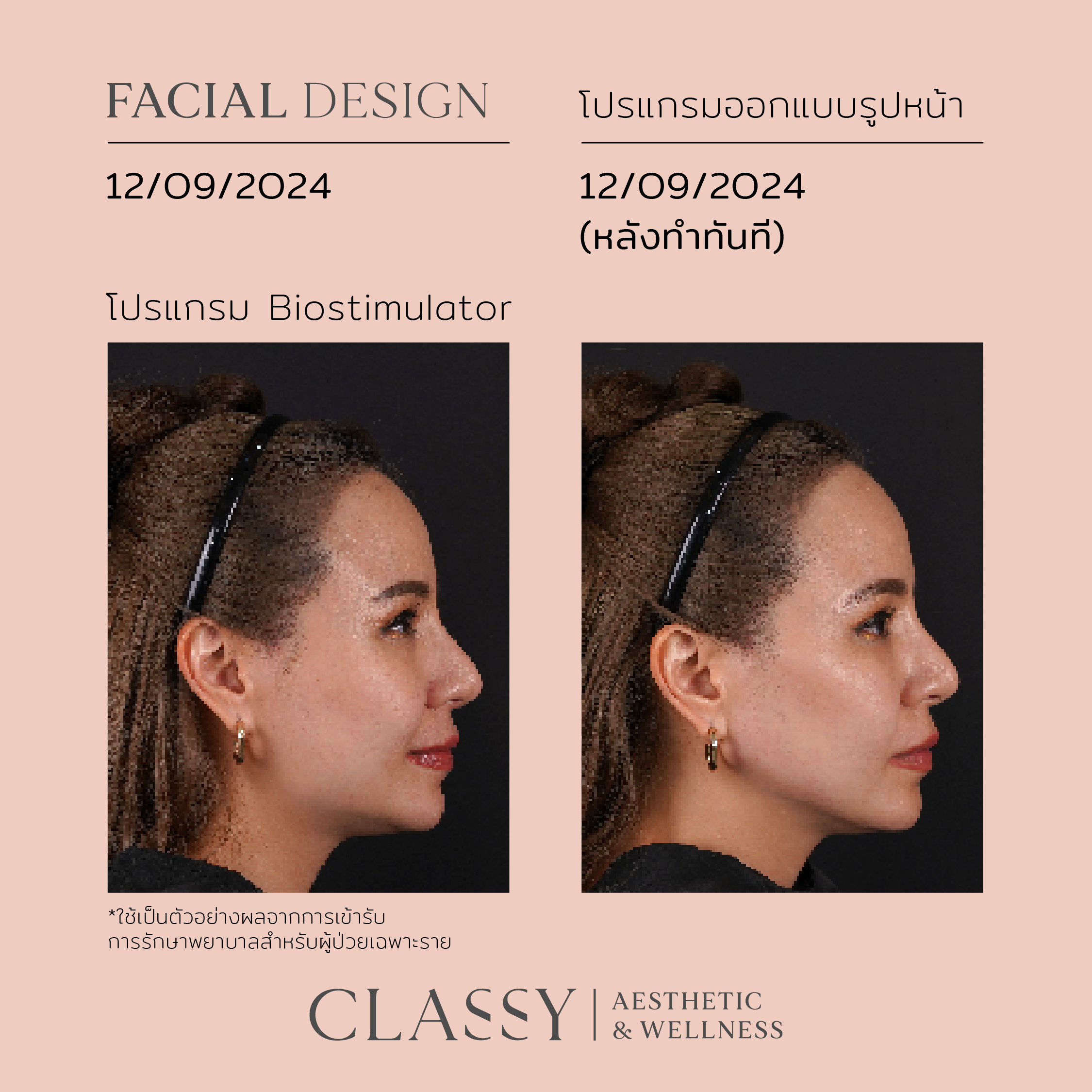 โบตั๋น-03