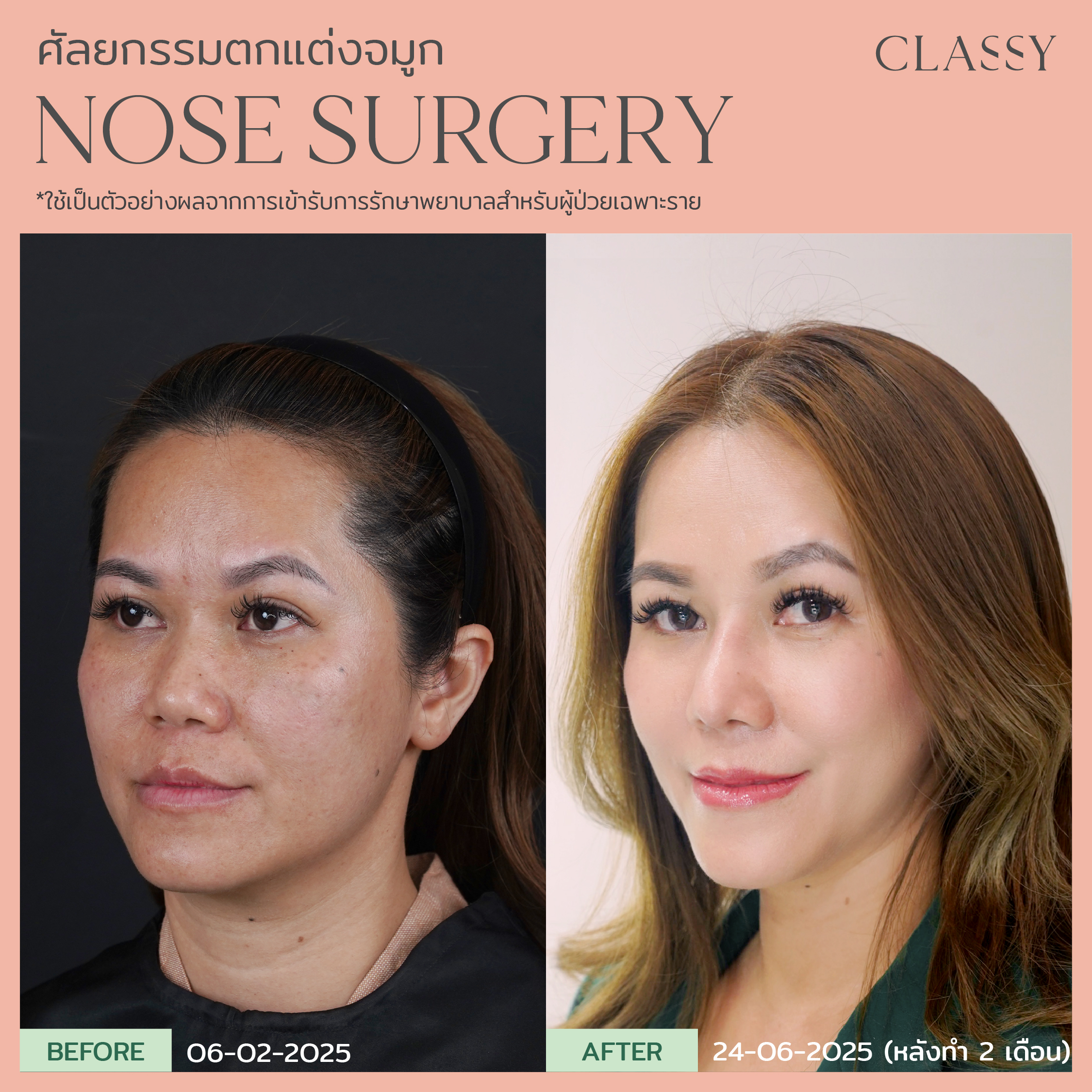 Before & After - Classy Clinic