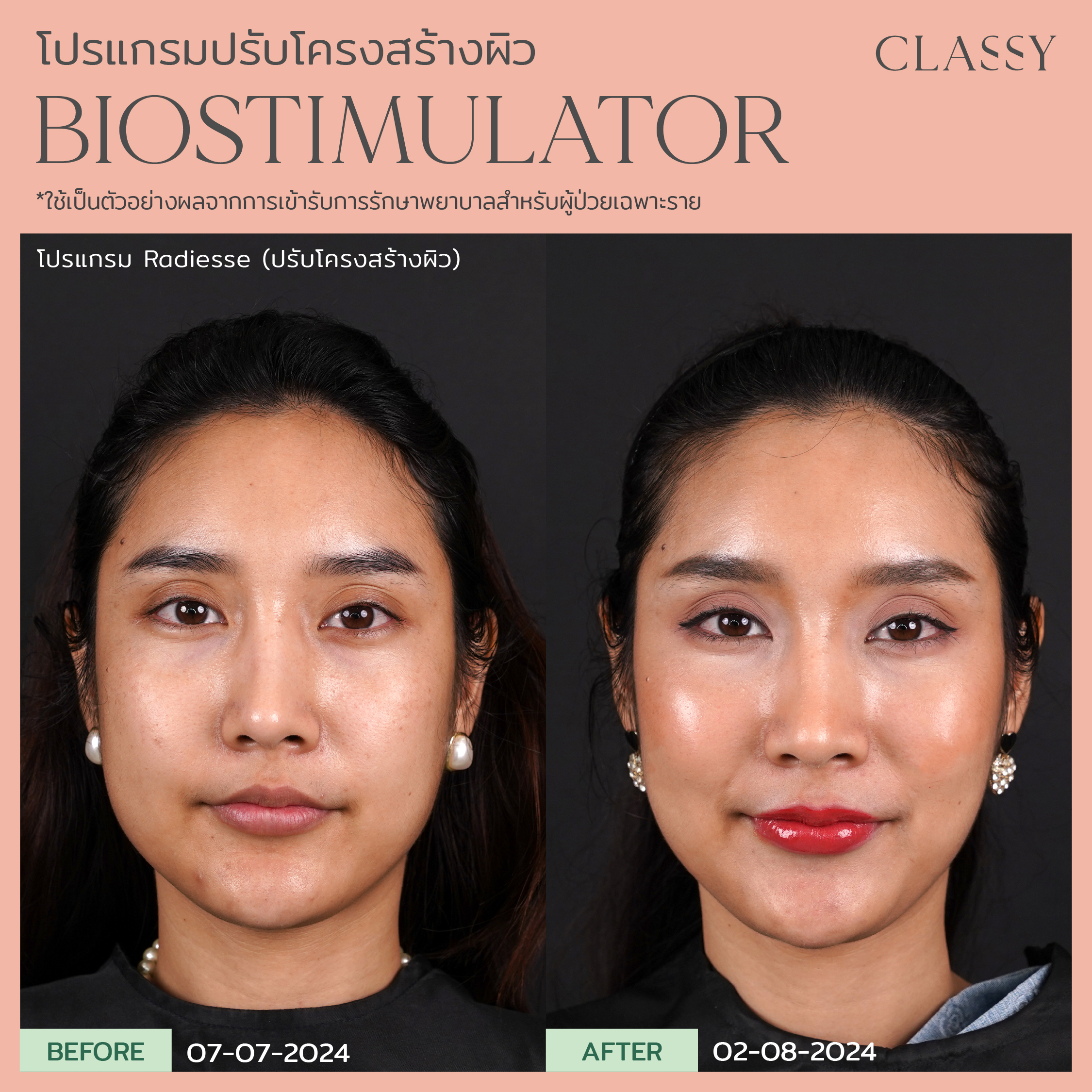 Before & After - Classy Clinic