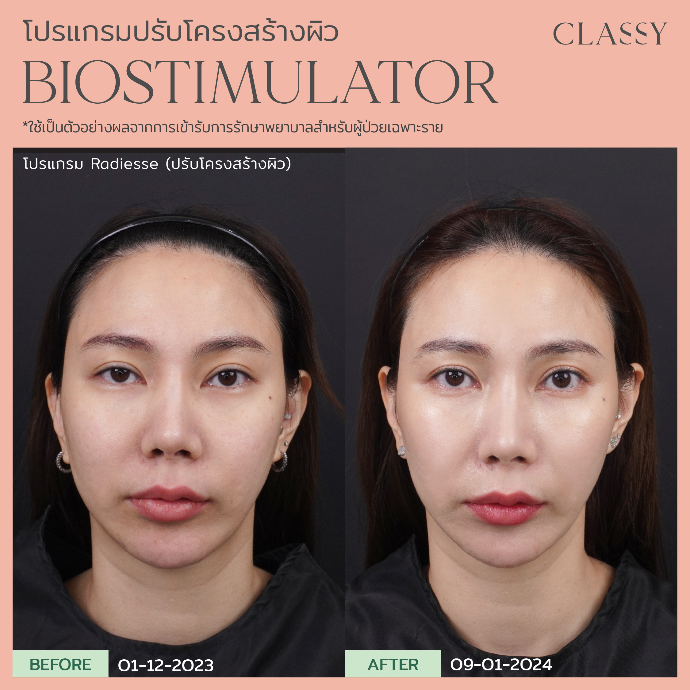 Before & After - Classy Clinic