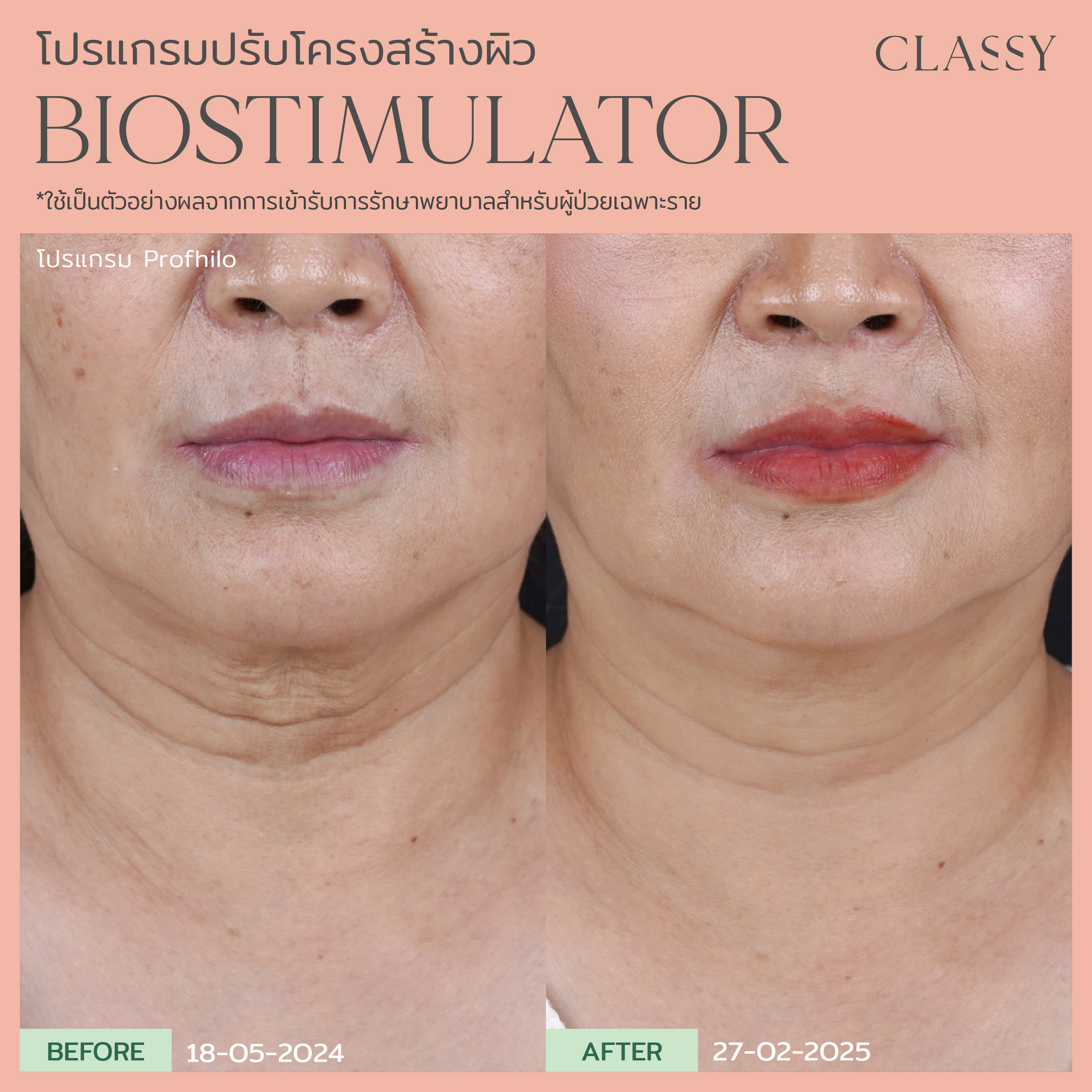 อย่ามองข้ามผิวคอ… จุดที่บอกอายุได้ชัดที่สุด 7 BA bistimmulator-19