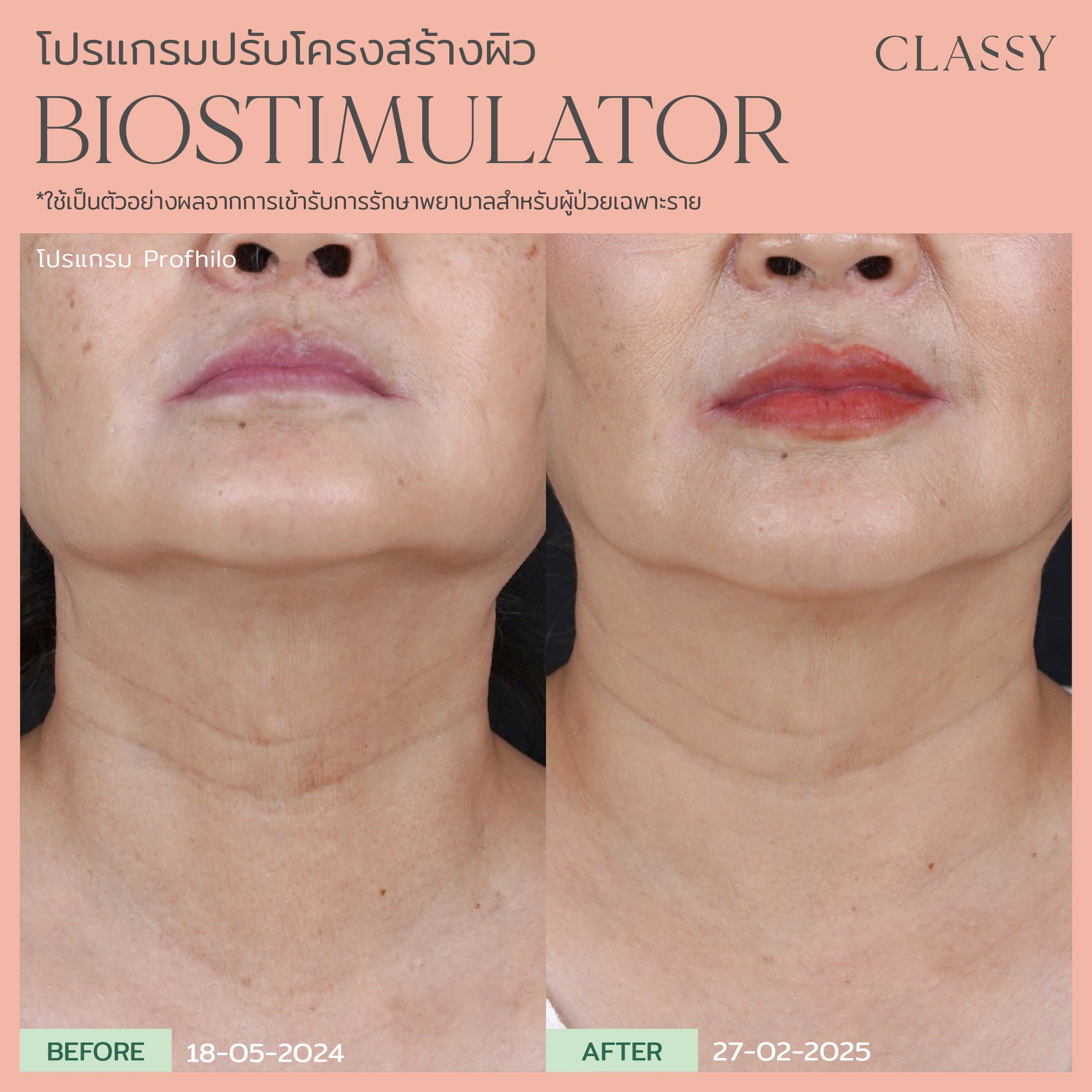อย่ามองข้ามผิวคอ… จุดที่บอกอายุได้ชัดที่สุด 8 BA bistimmulator-20