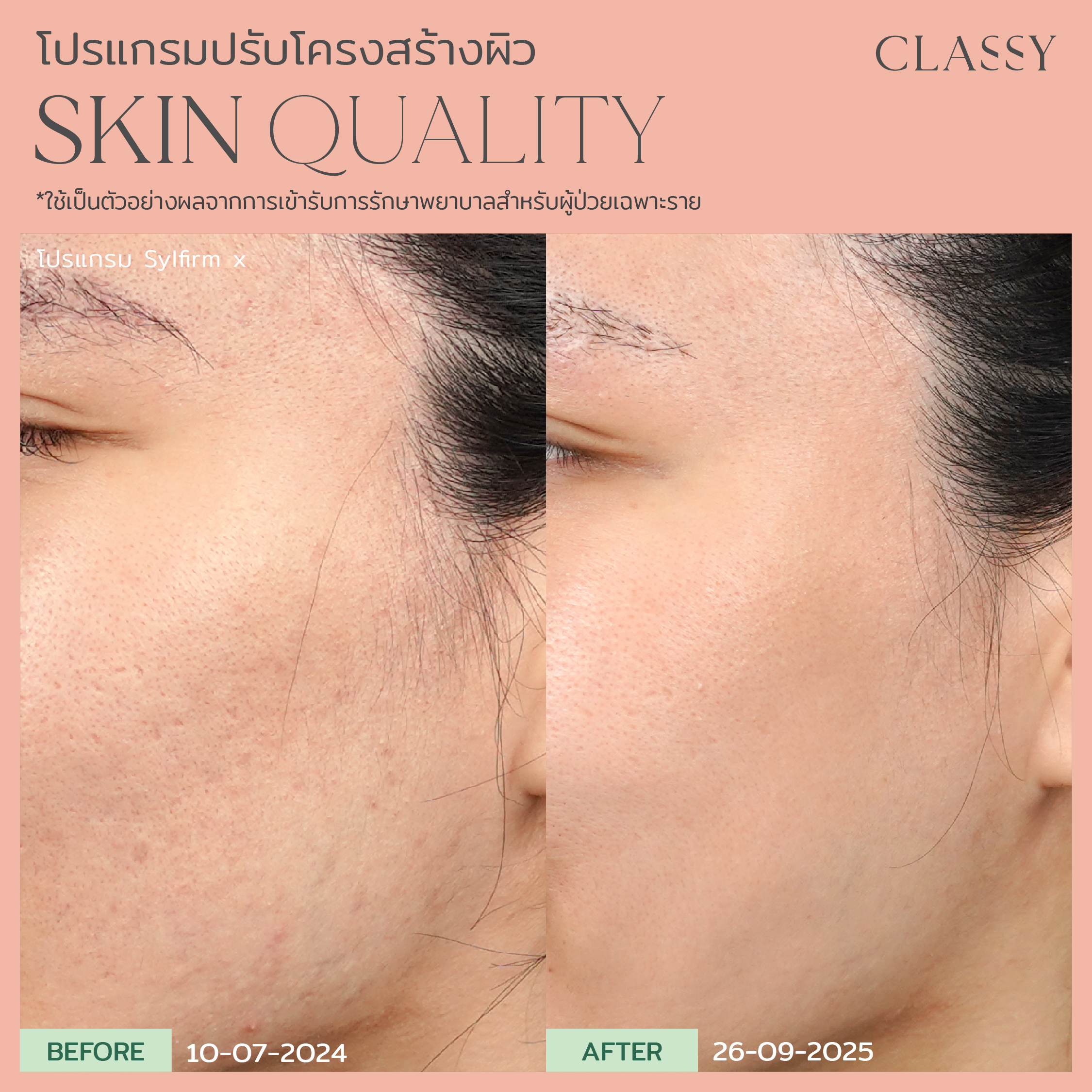 Before & After - Classy Clinic