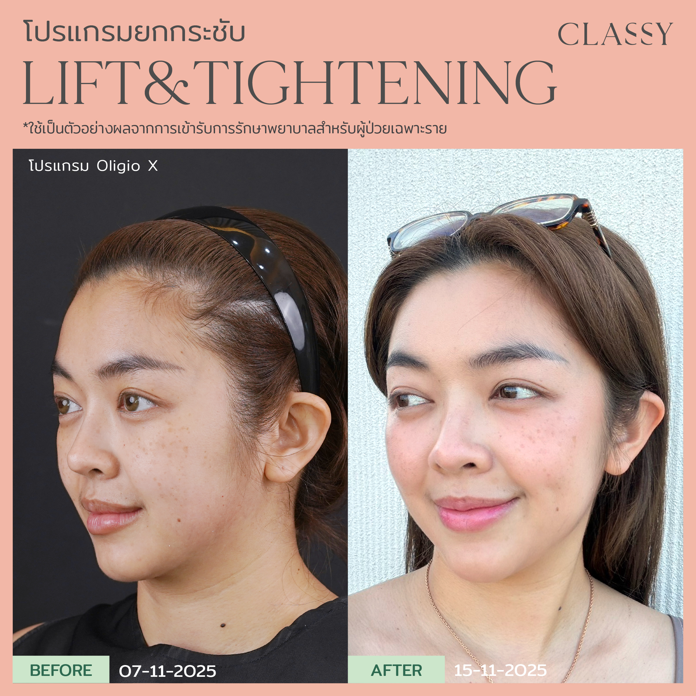 Home 69 BA lift&tightening -11