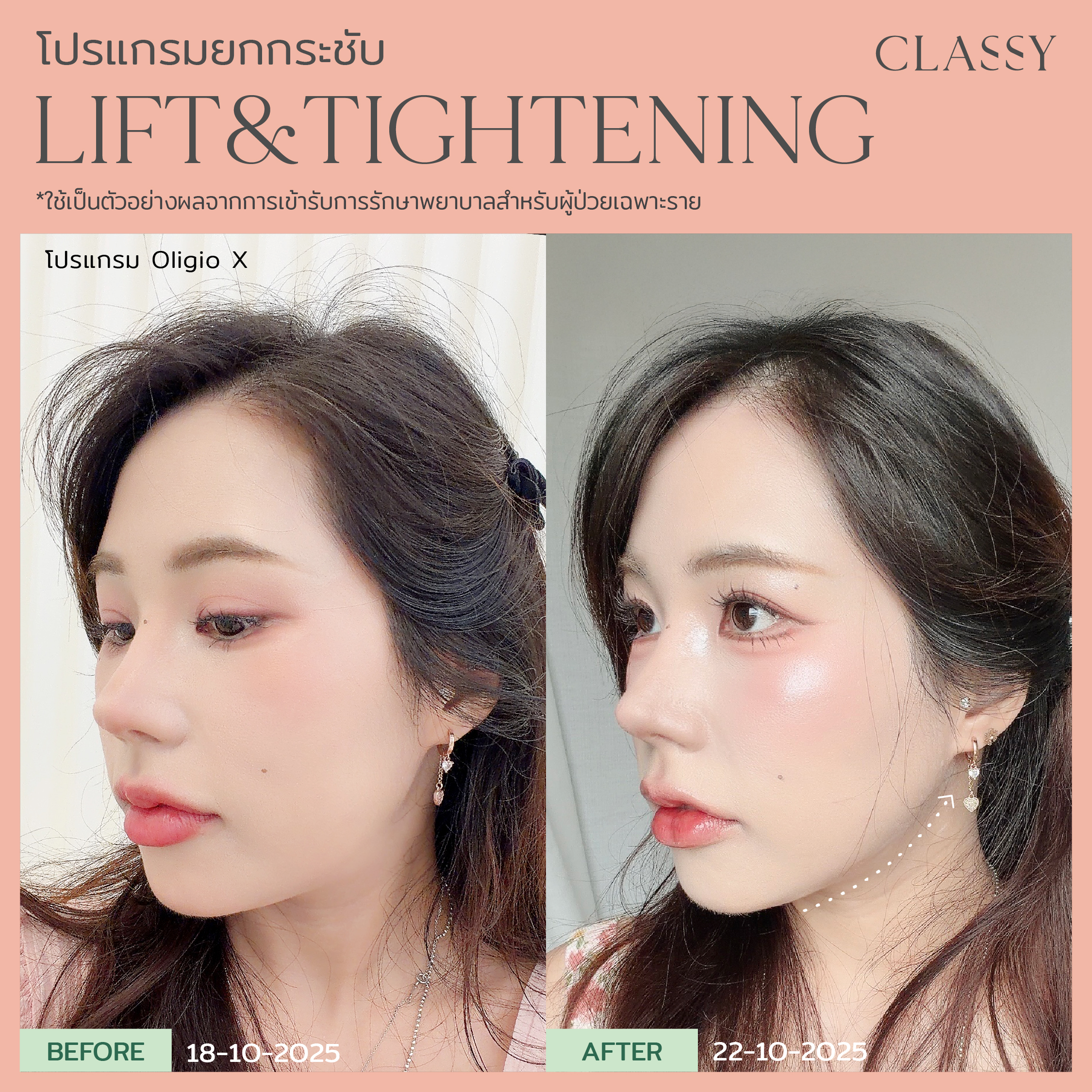 Home 68 BA lift&tightening -13