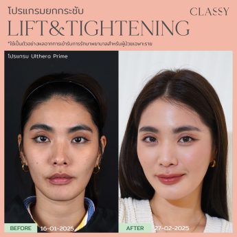 Ultherapy® PRIME 33 ชอโซ่-03
