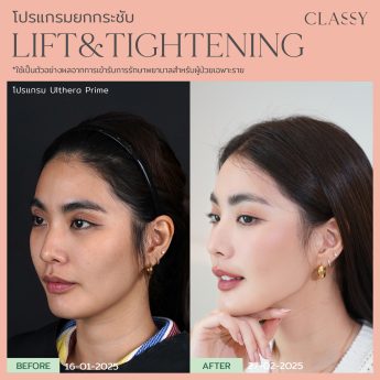 Ultherapy® PRIME 34 ชอโซ่-12