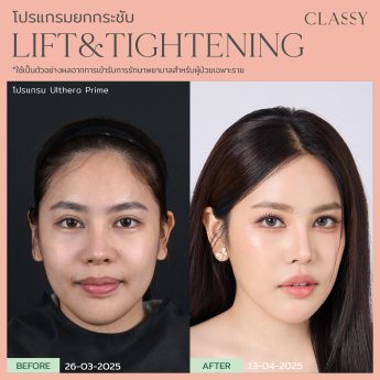 Ultherapy® PRIME 29 BA lift&tightening -11