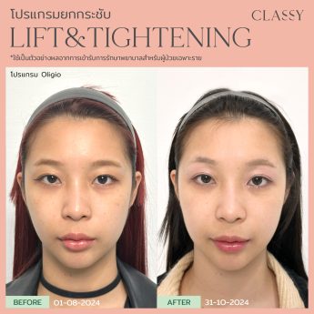 OLIGIO 11 BA lift&tightening -11