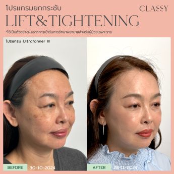 OLIGIO 13 BA lift&tightening -12