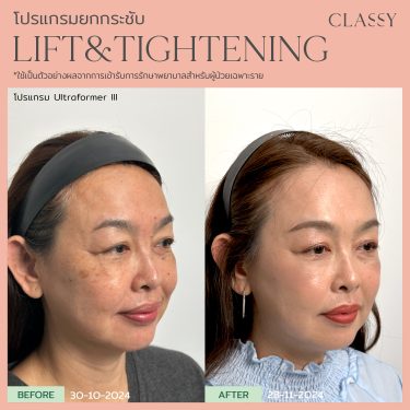 BA lift&tightening -12