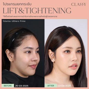 Ultherapy® PRIME 30 BA lift&tightening -12