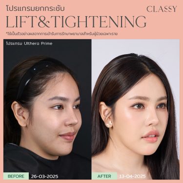 BA lift&tightening -12