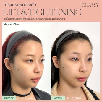 OLIGIO 12 BA lift&tightening -12