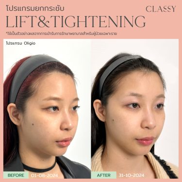 BA lift&tightening -12