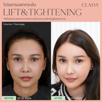 Thermage 36 BA lift&tightening. -03