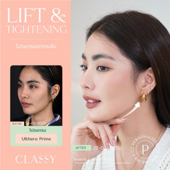 Ultherapy® PRIME 8 BA + รูปสวย-02