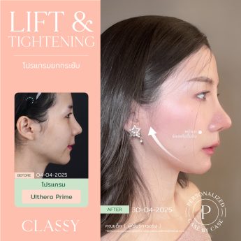 Ultherapy® PRIME 7 BA + รูปสวย-03
