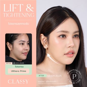 Ultherapy® PRIME 6 BA + รูปสวย-04