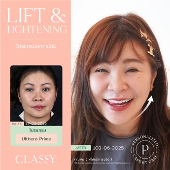 Ultherapy® PRIME 5 BA + รูปสวย-05