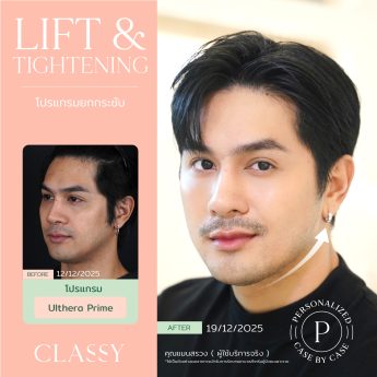 Ultherapy® PRIME 4 BA + รูปสวย-06