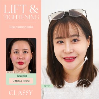 Ultherapy® PRIME 3 BA + รูปสวย-07