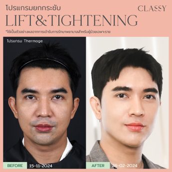 Thermage 33 BA รูปสวย thermage_Artboard 15 copy 2