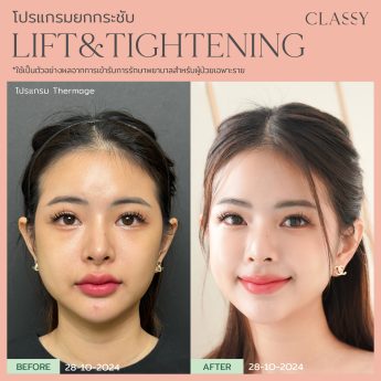 Thermage 34 BA รูปสวย thermage_Artboard 15 copy 3