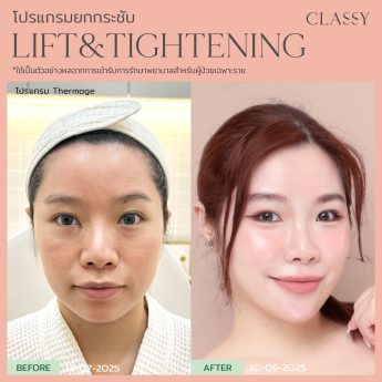 Thermage 35 BA รูปสวย thermage_Artboard 15 copy