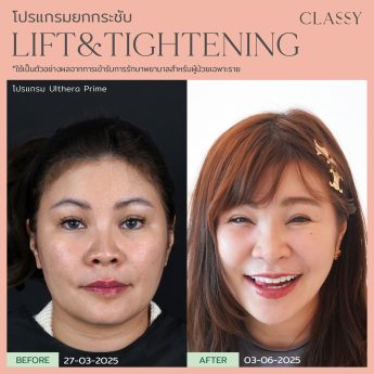 Ultherapy® PRIME 35 Rectangle 82