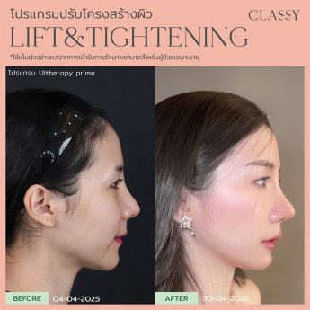 Ultherapy® PRIME 36 Rectangle 84