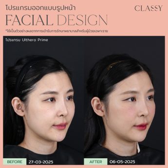 Ultherapy® PRIME 32 k แพร-18