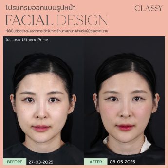 Ultherapy® PRIME 31 k แพร-19